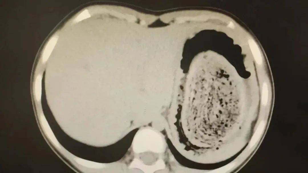 皇冠登3管理出租_发现1例皇冠登3管理出租，15岁女孩确诊！