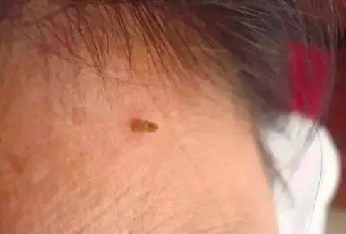 皇冠信用網在哪里开通
_脖子上长出的小肉粒皇冠信用網在哪里开通
,能揪吗?