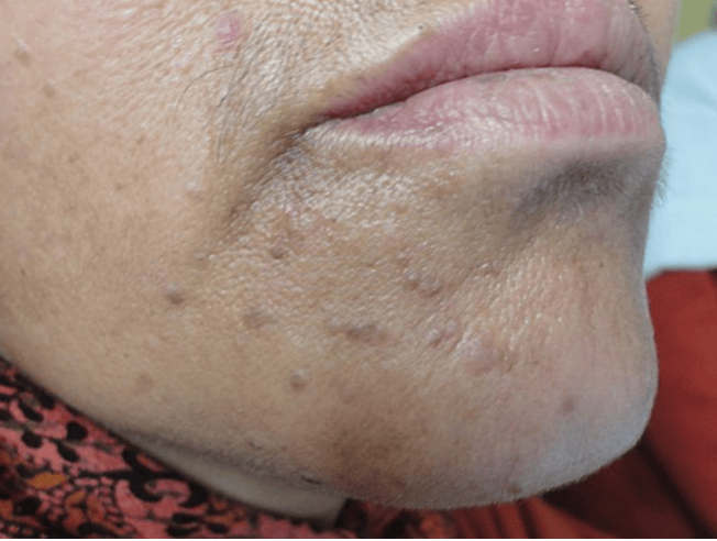 皇冠信用網在哪里开通
_脖子上长出的小肉粒皇冠信用網在哪里开通
,能揪吗?