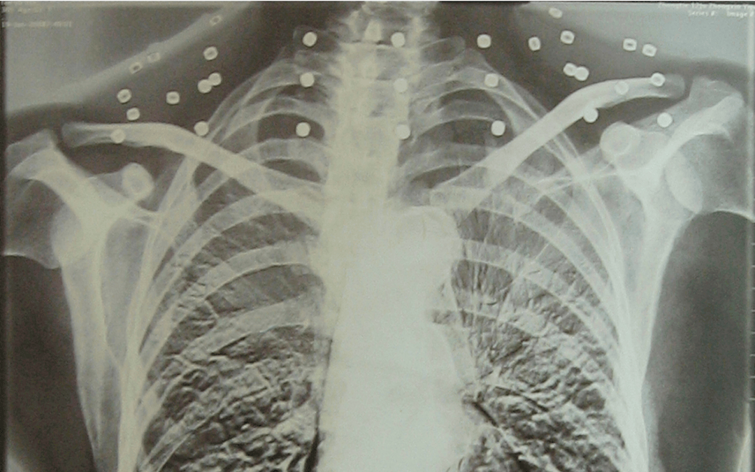 皇冠登一登二登三区别_“老先生皇冠登一登二登三区别，您把项链取下来再做CT”