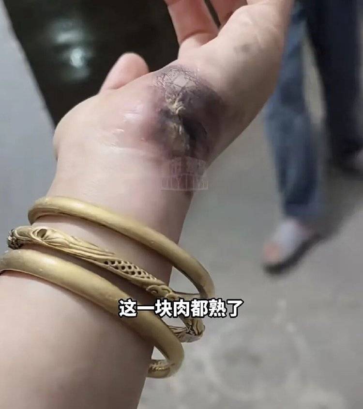 皇冠信用盘庄家
_手被烧熟!金手镯被烧熔!女子给电动车充电皇冠信用盘庄家
,不慎碰到充电口受伤